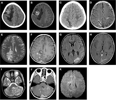 Computed Tomography and Magnetic Resonance Imaging in the Diagnosis of Cerebral Paragonimiasis in Children